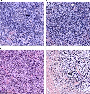 Tumor Microenvironment of Lymphomas and Plasma Cell Neoplasms: Broad Overview and Impact on Evaluation for Immune Based Therapies